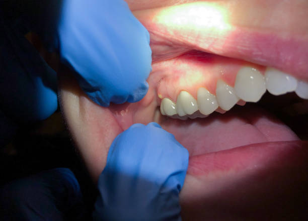 Best Dental Abscess Treatment in Syosset, NY